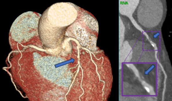 ​​​​​​​Das USB zeichnet Verbesserungen aus. Dieses Jahr gingen zwei der fünf KVP-Preise (kontinuierlicher Verbesserungsprozess) an Projekte der Radiologie: für den KI-Assistenten zur Effizienzsteigerung im Universitätsspital Basel und zur Optimierung der CT-Koronarangiografie.

