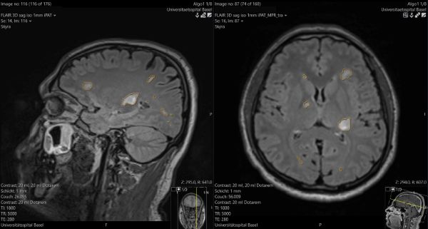 Den Nutzen eines von der Universität Basel entwickelten Algorithmus zur Erkennung von MS-Läsionen konnten wir in einer klinischen Studie nachweisen, den Zulassungsprozess abschliessen und können die Software nun in den klinischen Alltag integrieren. 
